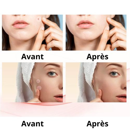 Patchs Anti-Boutons Hydrocolloïde Grand Format — 144 pièces